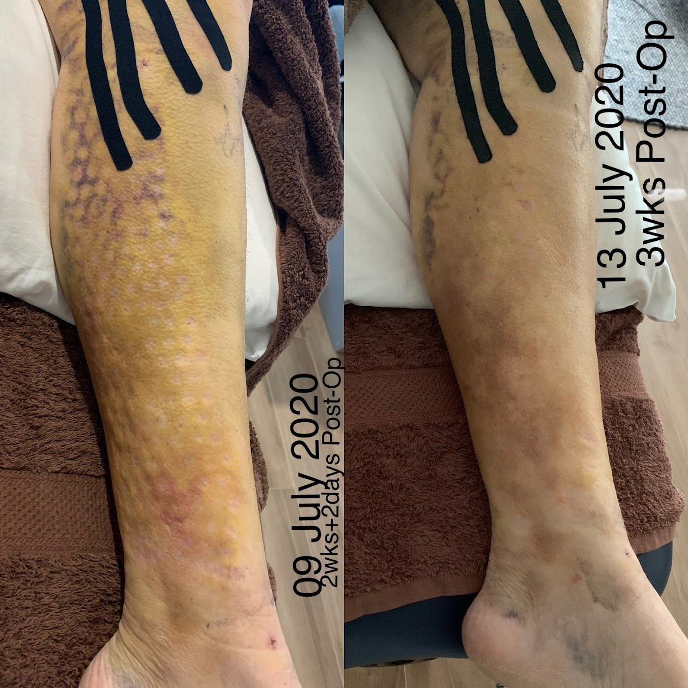 Post-Surgical Recovery