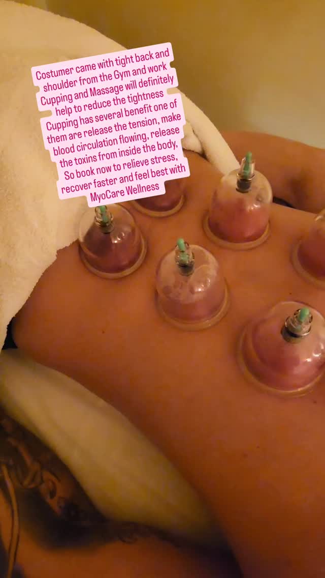 Cupping Therapy